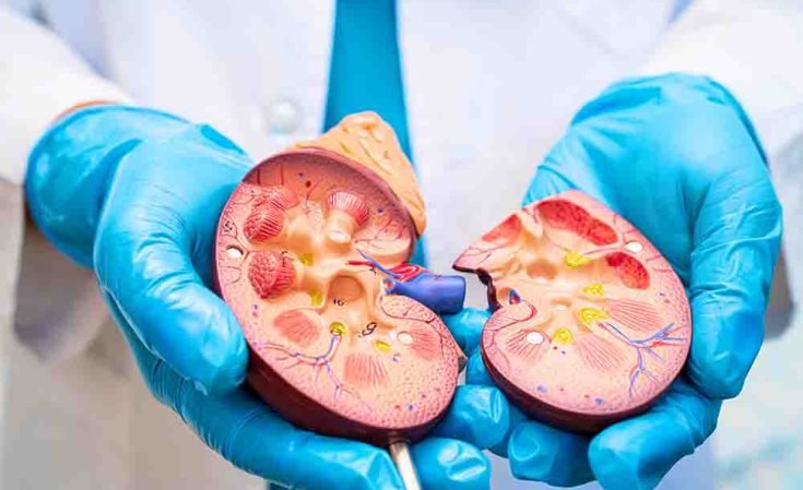 Kidney-Stones-Prevention
