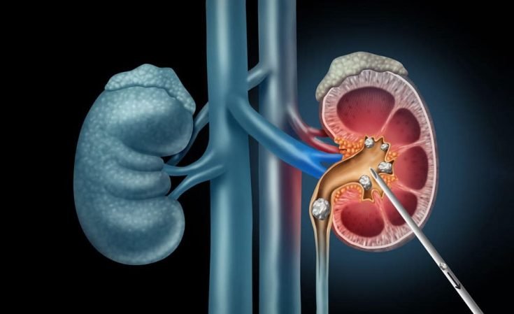 Percutaneous-Nephrolithotomy